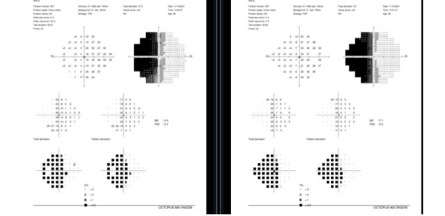 Dabid's Vision Field Test November 2021